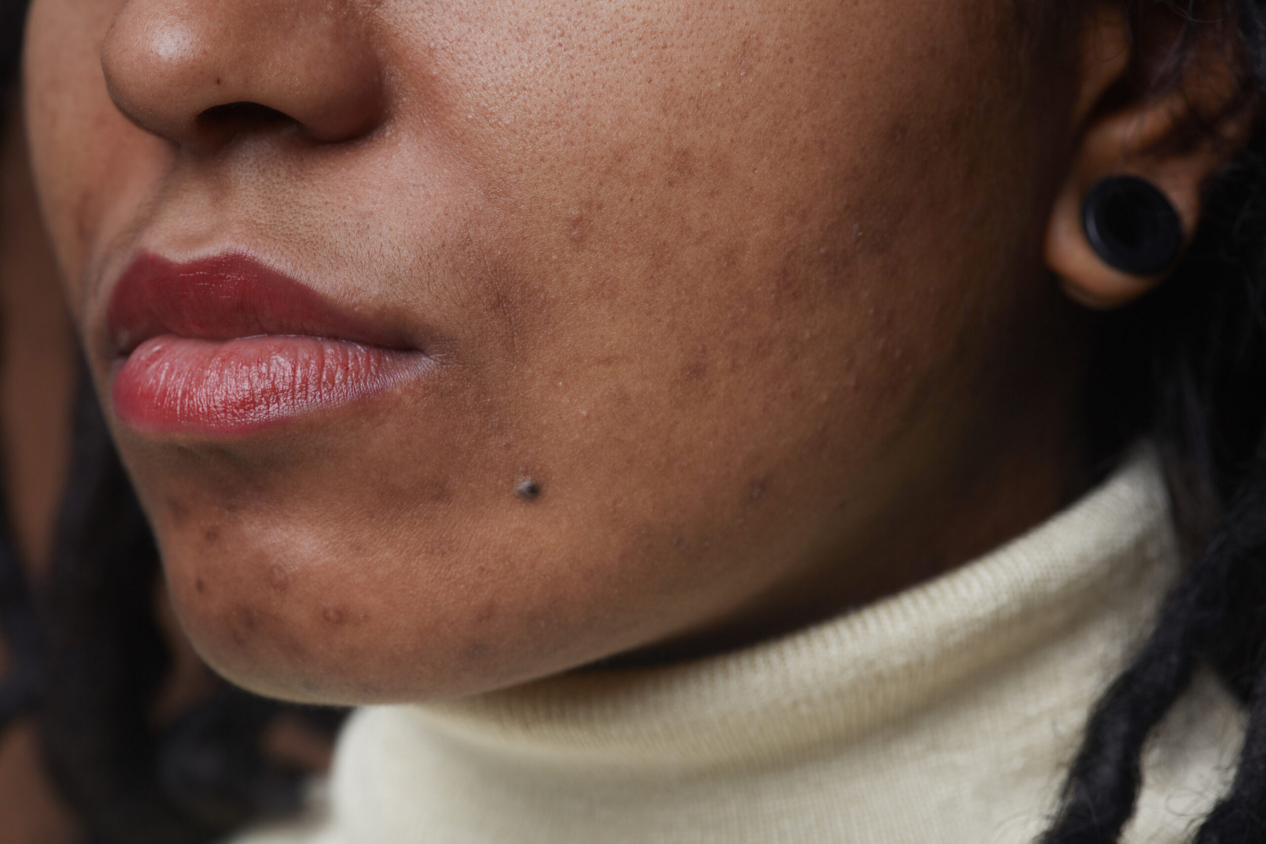 woman with acne scars